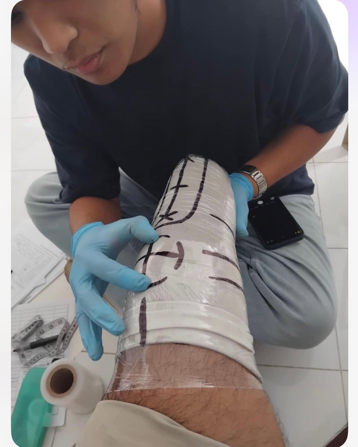 A person wearing blue gloves works on a cast around a patient's leg.